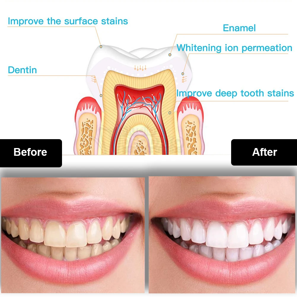 Kit de blanqueamiento Dental M - Teeth Whitening Near Me reseña y precio
